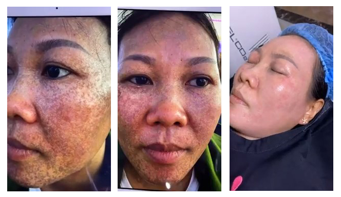 Top 5 địa chỉ trị nám Hải Phòng chuyên nghiệp 1 Top 5 địa chỉ trị nám tại Hải Phòng - Thẩm mỹ viện Bác sĩ Hà Thanh